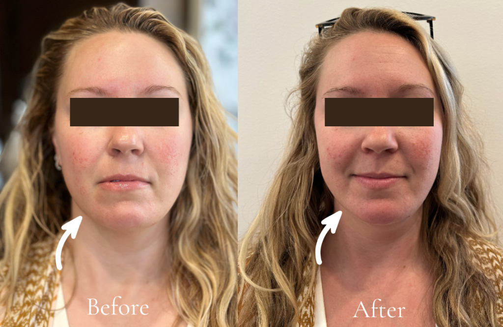 Before and after results of manual lymphatic drainage facial showing visibly lifted, toned, and sculpted skin using holistic techniques at Cecilia Berkley Holistic Spa.