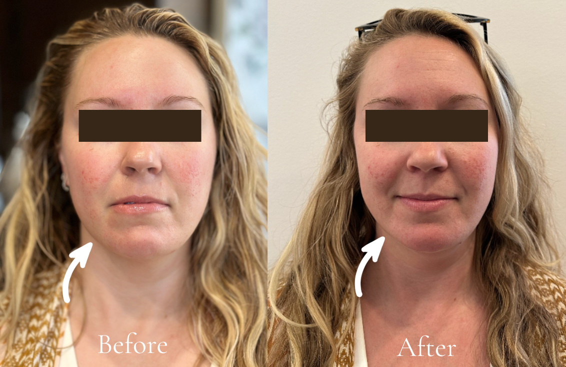 Before and after results of manual lymphatic drainage facial showing visibly lifted, toned, and sculpted skin using holistic techniques at Cecilia Berkley Holistic Spa.